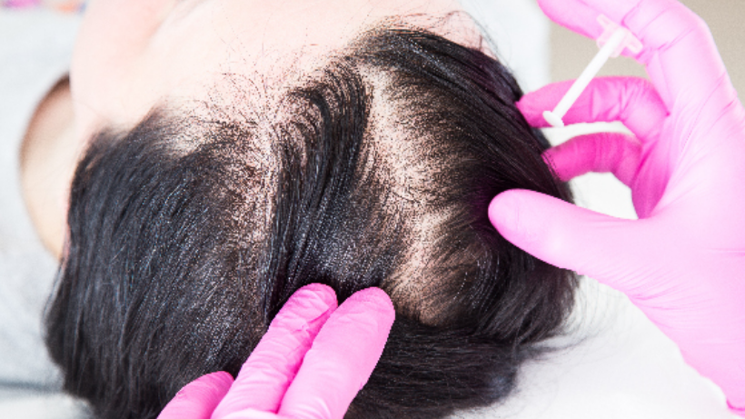PRF Treatment For Hair Loss Procedure Cost Benefits All You Need To Know prf-treatment-for-hair-loss-procedure-cost-benefits-all-you-need-to-know