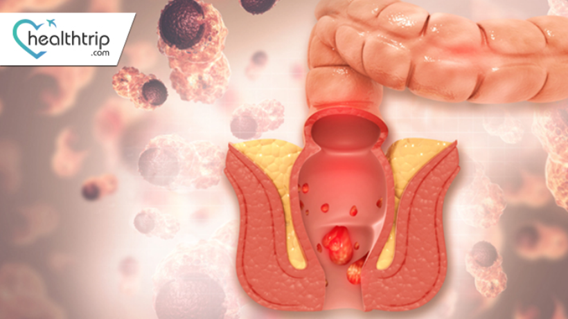 Anal Cancer: Types, Symptoms, and Prevention | HealthTrip